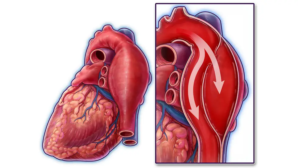 Bicuspid Aortic Valve Types Causes Symptoms Diagnosis Treatment And When To Seek Medical Bicuspid Aortic Valve Types Causes Symptoms Diagnosis Treatment And When To Seek Medical